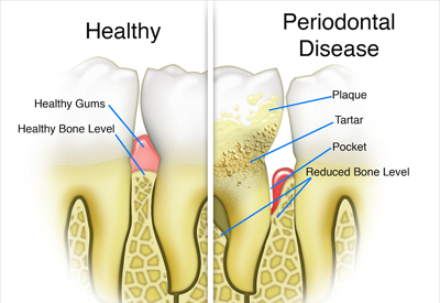 Gum Disease and Tooth and Bone Loss Manassas, VA