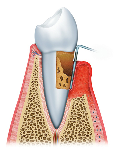 Stages of Gum Disease Manassas, VA