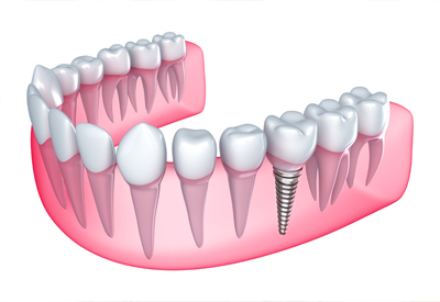 Single Missing Tooth in Manassas, VA