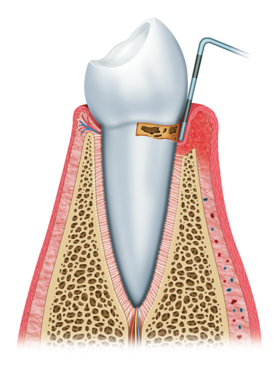 Stages of Gum Disease Manassas, VA