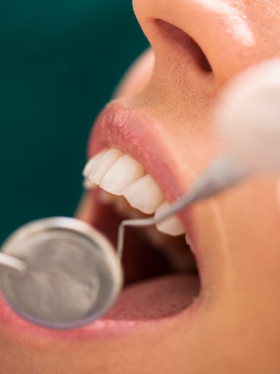 Periodontal Maintenance in Manassas, VA