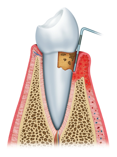 Stages of Gum Disease Manassas, VA